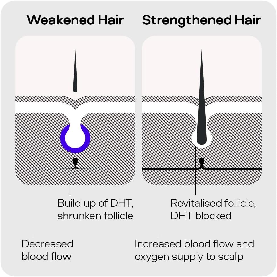Sons Minoxidil 5% Solution 3x60ml & Dermaroller Kit for Men