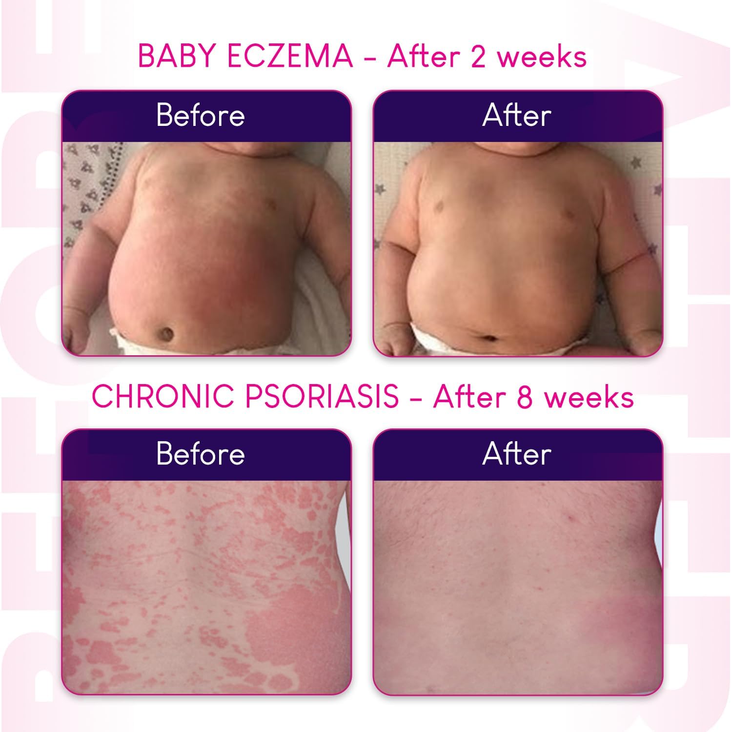 Before and after images of a baby with eczema and chronic psoriasis, showing improvement over time.