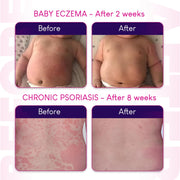 Before and after images of a baby with eczema and chronic psoriasis, showing improvement over time.